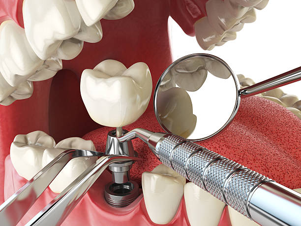 Best Emergency Tooth Extraction in Paola, KS